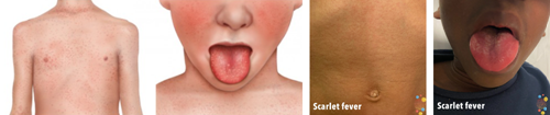 4 photographs 1 - patchy red rash over a light skinned boys torso, 2 - close up of light skinned boys cheecks and mouth. red cheeks and a bright red strawberry textured tongue. 3 - pink rash over child's torse with medium brown skin. 4 - close up of cheeks and mouth of a boy with medium brown skin. Cheeks are slightly pink, tongue red and white with strawberry texture.