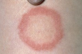 Circular pink rash on light skin around 2cm in diameter. Red ring with a pale centre.